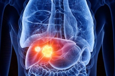 سرطان خاموش اما قابل پیشگیری / ۶۰ درصد موارد سرطان کبد قابل اجتناب است