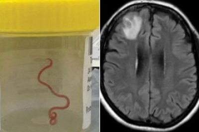 خارج کردن کرم ۱۸ سانتی‌متری از مغز یک مرد