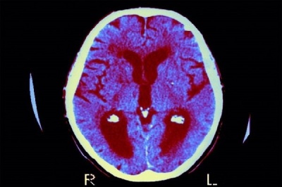 هورمون درمانی برای یایسگی به تقویت حافظه کمک می‌کند