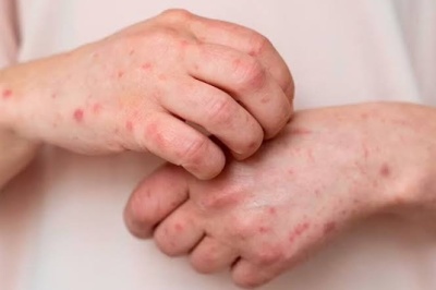 وضعیت بروز آبله‌مرغان در ایران / افراد در معرض خطر این بیماری