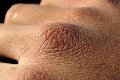 چگونه از خشکی پوست در پاییز جلوگیری کنیم؟