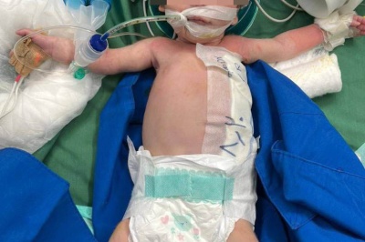 انجام موفقیت‌آمیز عمل جراحی کیست مادرزادی جدار شکم بر روی نوزاد ۱۱ روزه