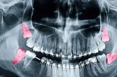 رادیوگرافی دندانی در دوران بارداری بی‌خطر است