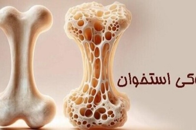 پوکی استخوان در کودکان، واقعیتی فراموش‌شده