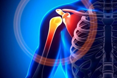 شانه یخ‌زده چیست؟