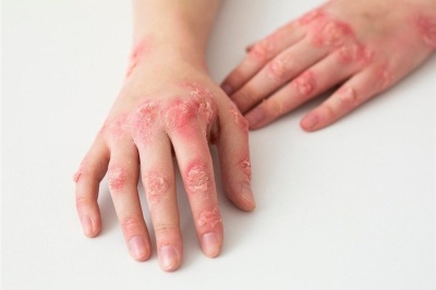 موارد ابتلا به «پسوریازیس» در جهان افزایش یافت