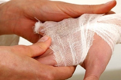 بستری سالانه 30هزار نفر بر اثر سوختگی در کشور/ باورهای غلط مانع درمان به موقع بیماران