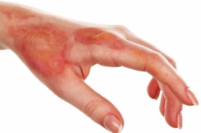 از درمان‌های سنتی سوختگی پرهیز کنید