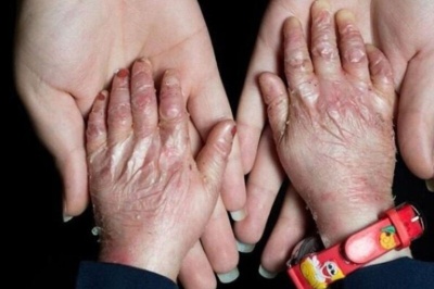 بنیاد امور بیماری‌های خاص هنوز به شکایات و مطالبات بیماران‌ پروانه‌ای پاسخی نداده است!