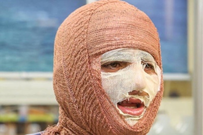 سالانه حدود ۳۰۰ هزار نفر به مراکز سوختگی کشور مراجعه می‌کنند