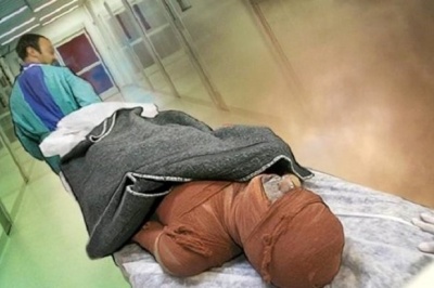 سوختگی در ایران؛ آماری فراتر از حادثه / سالی ۳۰۰۰۰۰ سوختگی و زنگ خطر ایمنی در کشور